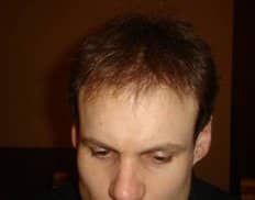 Slider image (4) Vita Hair | Clinica Capilar